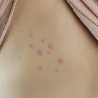 bed bug bites on skin