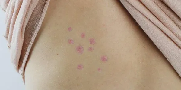 bed bug bites on skin